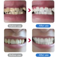 💎UP TO 50% OFF!!🦷✨Electric Ultrasonic Dental Scaler for Tartar and Plaque Removal - Image 6